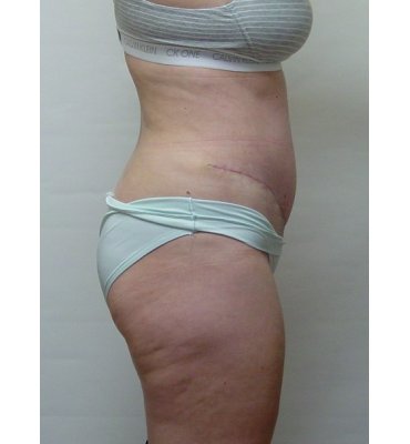 abdominoplasty side view after